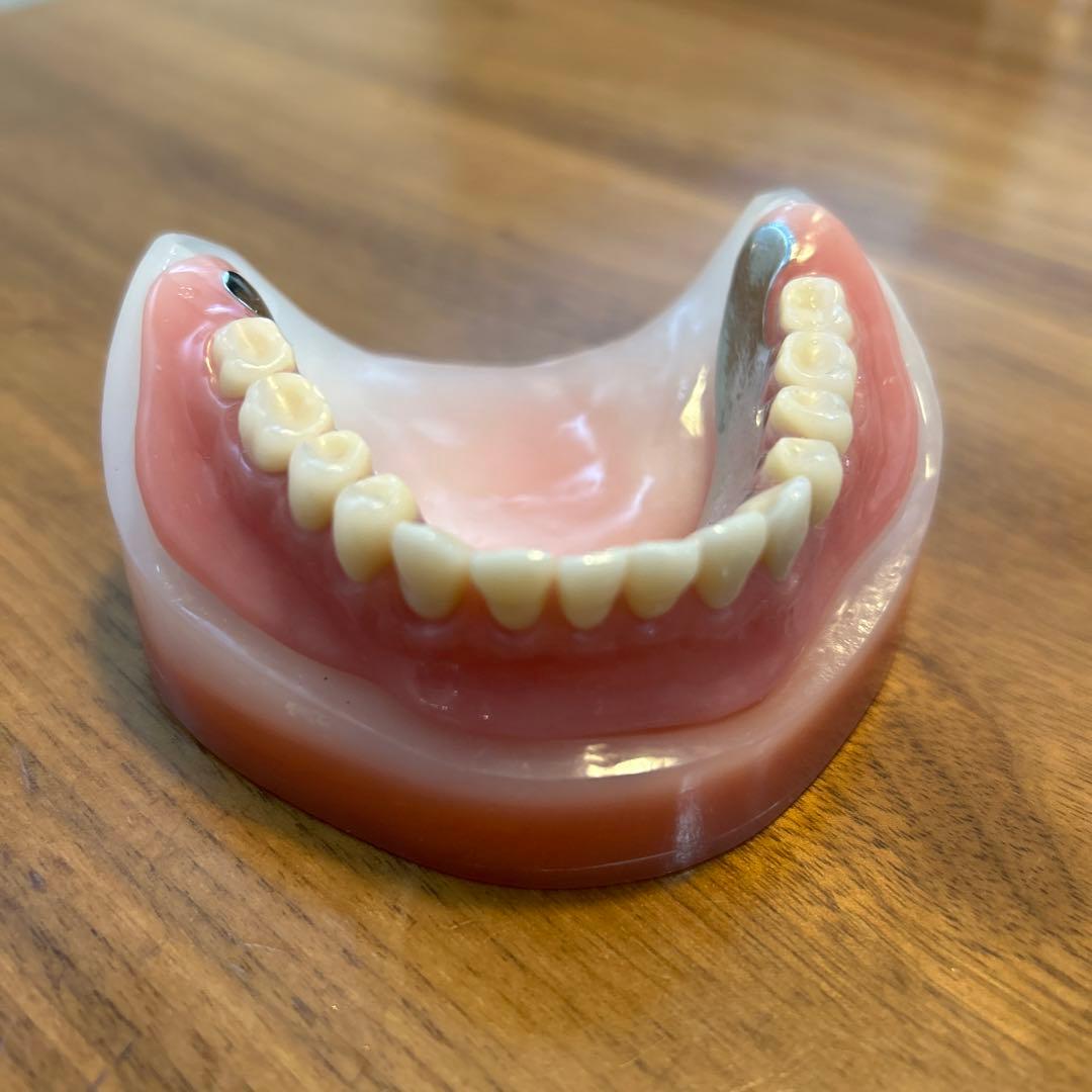 歯科サンプル　金属床義歯　模型付き　歯科医院